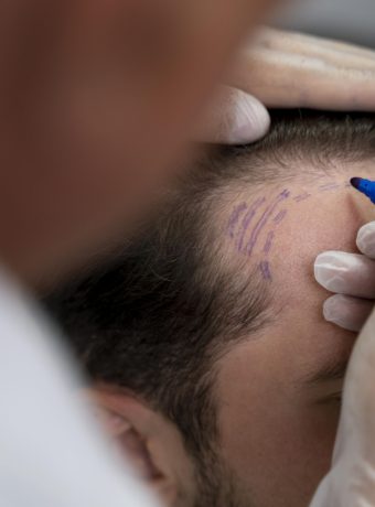 Hair transplantation by saketh skin care