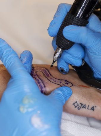 Tattoo removal by sakethskincare (skin clinic in nellore)