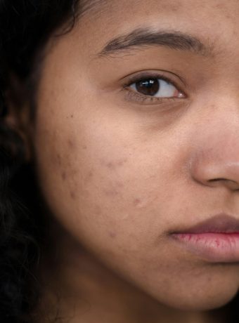 acne-scars-saketh skin care